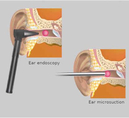 microsuction